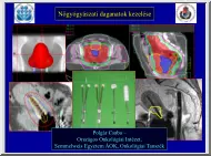 Polgár Csaba - Nőgyógyászati daganatok kezelése